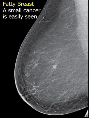 Mammogram