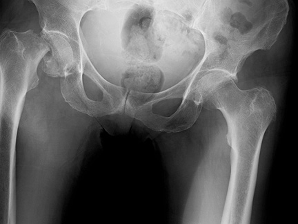 hip fracture