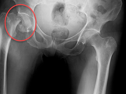 hip fracture