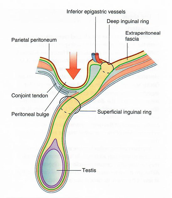 Direct hernia
