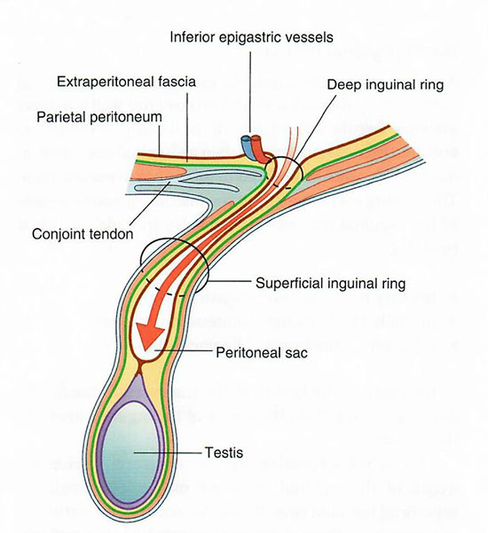 Indirect hernia