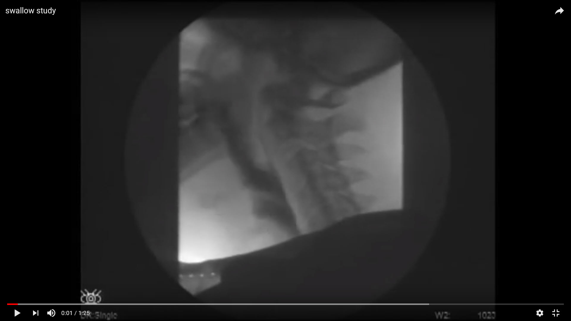 epiglottus