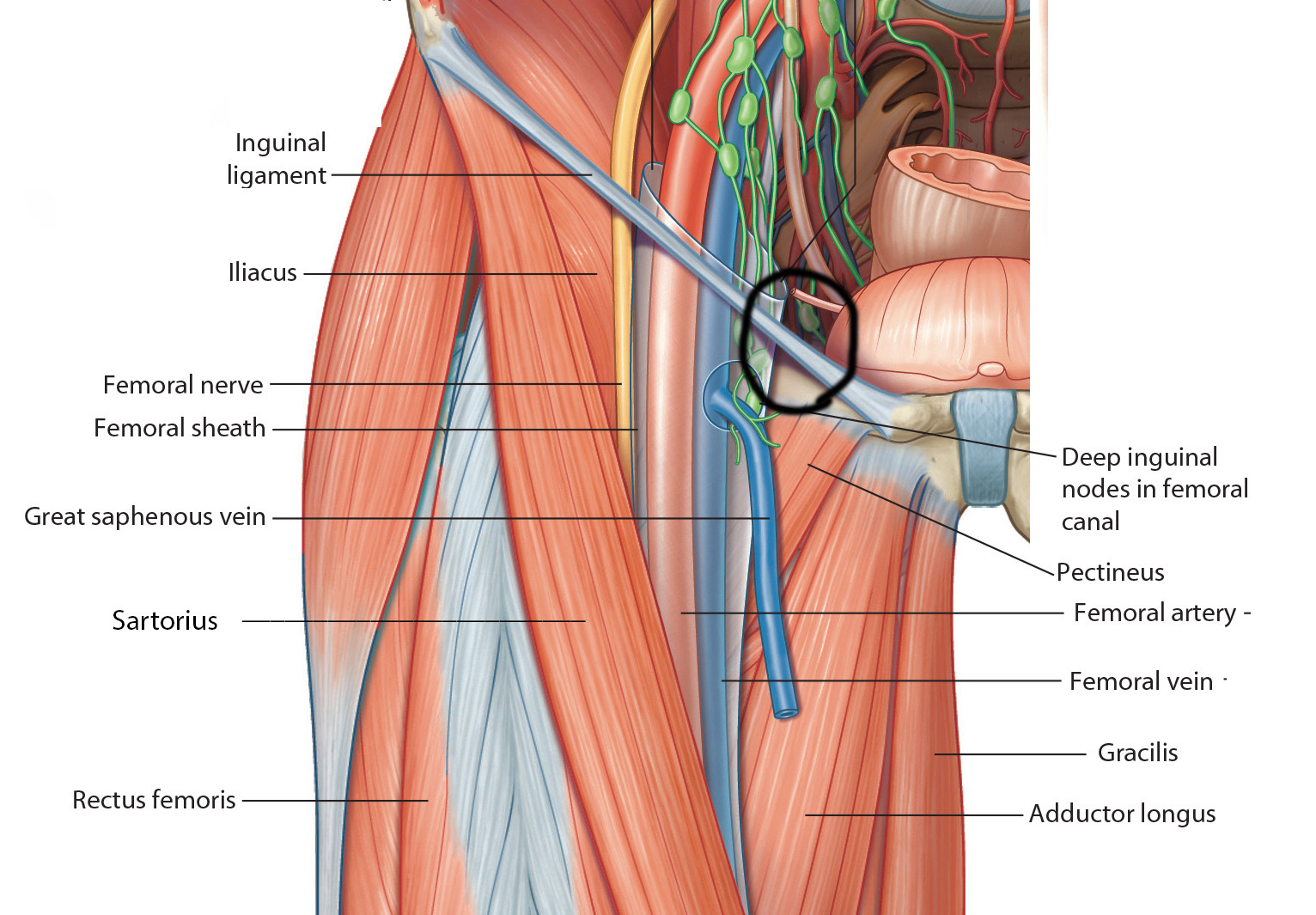 femoral hernia